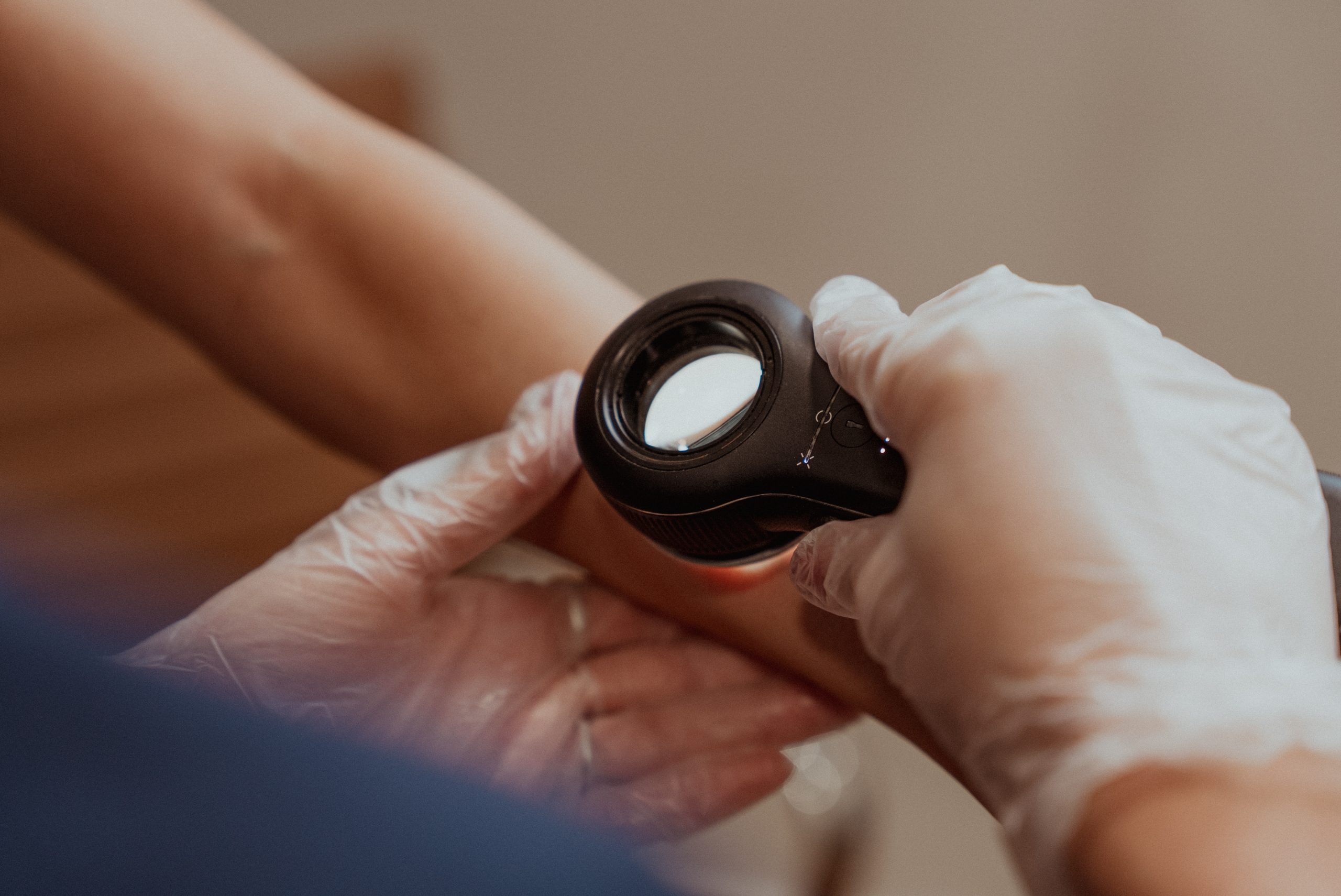Gloved hands using a dermatoscope to examine skin