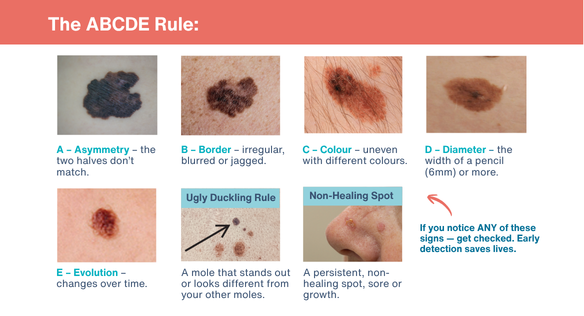 The ABCDE rule for checking moles, with photographs illustrating asymmetry, border, colour, diameter and evolution, plus the ugly duckling rule and a non-healing spot.