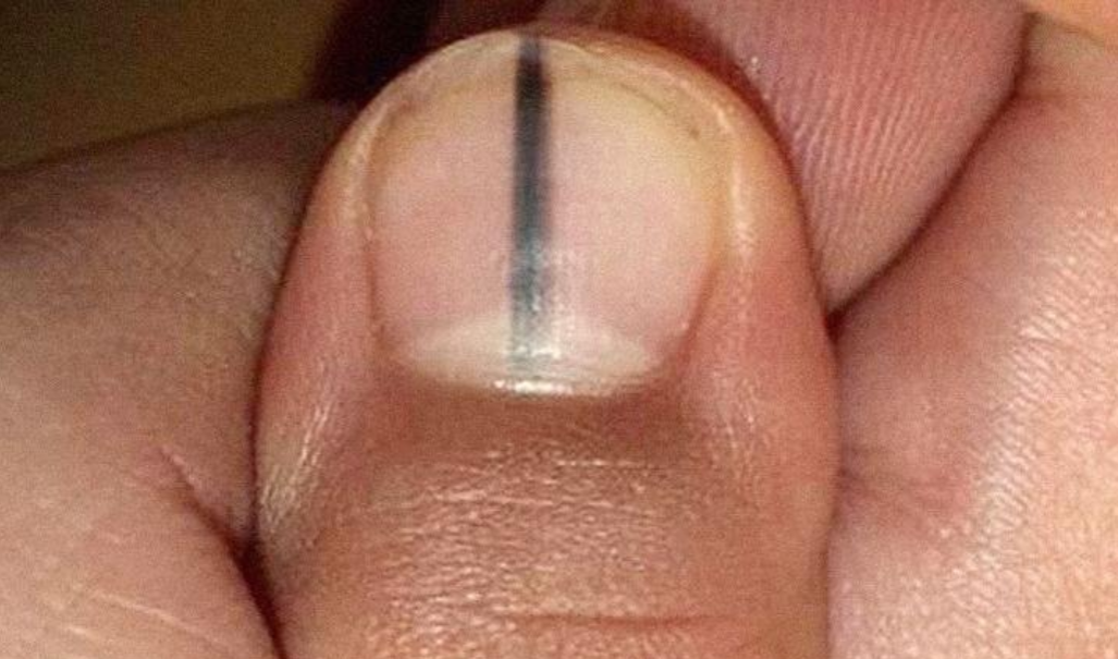 Moles on hands, feet and nails: what to look out for
